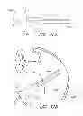 Fig. 63 - Suture passer systems and methods for palate suspension and compression