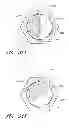 Fig. 67 - Suture passer systems and methods for palate suspension and compression