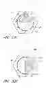 Fig. 68 - Suture passer systems and methods for palate suspension and compression