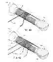Fig. 04 - SUTURE PULLER