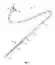 Fig. 02 - Method and system for treating valve stenosis