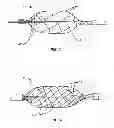 Fig. 04 - Method and system for treating valve stenosis