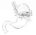Fig. 01 - METHODS AND DEVICES FOR DEPLOYING AND RELEASING A TEMPORARY IMPLANT WITHIN THE BODY