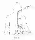 Fig. 02 - METHODS AND DEVICES FOR DEPLOYING AND RELEASING A TEMPORARY IMPLANT WITHIN THE BODY