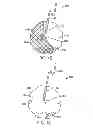 Fig. 03 - METHODS AND DEVICES FOR DEPLOYING AND RELEASING A TEMPORARY IMPLANT WITHIN THE BODY