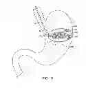 Fig. 04 - METHODS AND DEVICES FOR DEPLOYING AND RELEASING A TEMPORARY IMPLANT WITHIN THE BODY