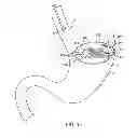 Fig. 05 - METHODS AND DEVICES FOR DEPLOYING AND RELEASING A TEMPORARY IMPLANT WITHIN THE BODY