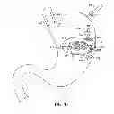 Fig. 06 - METHODS AND DEVICES FOR DEPLOYING AND RELEASING A TEMPORARY IMPLANT WITHIN THE BODY