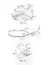 Fig. 09 - METHODS AND DEVICES FOR DEPLOYING AND RELEASING A TEMPORARY IMPLANT WITHIN THE BODY