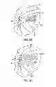 Fig. 10 - METHODS AND DEVICES FOR DEPLOYING AND RELEASING A TEMPORARY IMPLANT WITHIN THE BODY