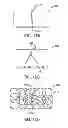 Fig. 18 - METHODS AND DEVICES FOR DEPLOYING AND RELEASING A TEMPORARY IMPLANT WITHIN THE BODY