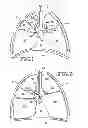 Fig. 02 - Removable lung reduction devices, systems, and methods