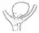 Fig. 01 - Endovascular closure device