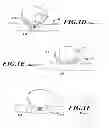 Fig. 03 - Endovascular closure device