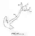 Fig. 04 - Endovascular closure device