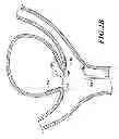 Fig. 06 - Endovascular closure device