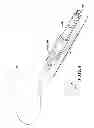 Fig. 08 - Endovascular closure device