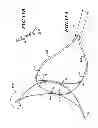 Fig. 13 - Endovascular closure device