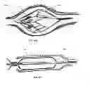 Fig. 21 - MULTI-LUMEN CENTRAL ACCESS VENA CAVA FILTER APPARATUS FOR CLOT MANAGEMENT AND METHOD OF USING SAME
