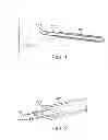 Fig. 02 - METHODS AND DEVICES FOR SUTURE ANCHOR DELIVERY