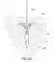 Fig. 07 - Medical device, kit and method for constricting tissue or a bodily orifice, for example, a mitral valve