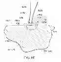 Fig. 09 - Medical device, kit and method for constricting tissue or a bodily orifice, for example, a mitral valve
