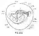 Fig. 43 - Medical device, kit and method for constricting tissue or a bodily orifice, for example, a mitral valve