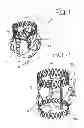 Fig. 02 - Cardiac valve prosthesis