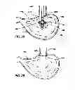 Fig. 12 - IMPLANTABLE DEVICES FOR CONTROLLING THE SIZE AND SHAPE OF AN ANATOMICAL STRUCTURE OR LUMEN