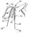Fig. 01 - Horse hair braiding device and method