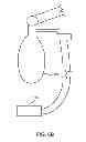 Fig. 08 - Apparatus, System and Method of Remotely Actuating a Manual Ventilation Bag