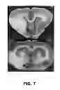 Fig. 08 - DODECAFLUOROPENTANE EMULSION AS A STROKE AND ISCHEMIA THERAPY