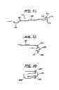 Fig. 10 - THERAPEUTIC AGENT ELUTION CONTROL PROCESS