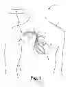 Fig. 02 - Criteria for optimal electrical resynchronization during biventricular pacing