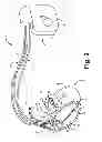 Fig. 03 - Criteria for optimal electrical resynchronization during biventricular pacing