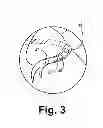Fig. 04 - Criteria for optimal electrical resynchronization during biventricular pacing