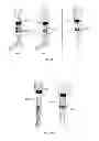 Fig. 09 - ELECTRICAL STIMULATION METHOD FOR REDUCTION OF JOINT COMPRESSION