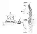 Fig. 01 - High frequency neuromodulation system and method for reducing energy requirements