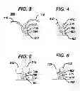 Fig. 03 - SEALING MECHANISM FOR EXPANDABLE VASCULAR DEVICE