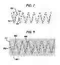 Fig. 04 - SEALING MECHANISM FOR EXPANDABLE VASCULAR DEVICE