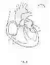 Fig. 02 - Method and apparatus for heart valve surgery