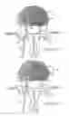 Fig. 22 - METHODS OF REPAIRING HERNIATED SEGMENTS IN THE DISC
