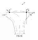 Fig. 11 - Generation of a computerized bone model representative of a pre-degenerated state and useable in the design and manufacture of arthroplasty devices