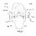 Fig. 13 - Generation of a computerized bone model representative of a pre-degenerated state and useable in the design and manufacture of arthroplasty devices