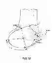 Fig. 14 - Generation of a computerized bone model representative of a pre-degenerated state and useable in the design and manufacture of arthroplasty devices