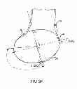 Fig. 16 - Generation of a computerized bone model representative of a pre-degenerated state and useable in the design and manufacture of arthroplasty devices