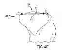 Fig. 22 - Generation of a computerized bone model representative of a pre-degenerated state and useable in the design and manufacture of arthroplasty devices
