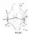 Fig. 24 - Generation of a computerized bone model representative of a pre-degenerated state and useable in the design and manufacture of arthroplasty devices