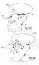 Fig. 30 - Generation of a computerized bone model representative of a pre-degenerated state and useable in the design and manufacture of arthroplasty devices