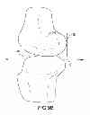 Fig. 41 - Generation of a computerized bone model representative of a pre-degenerated state and useable in the design and manufacture of arthroplasty devices
